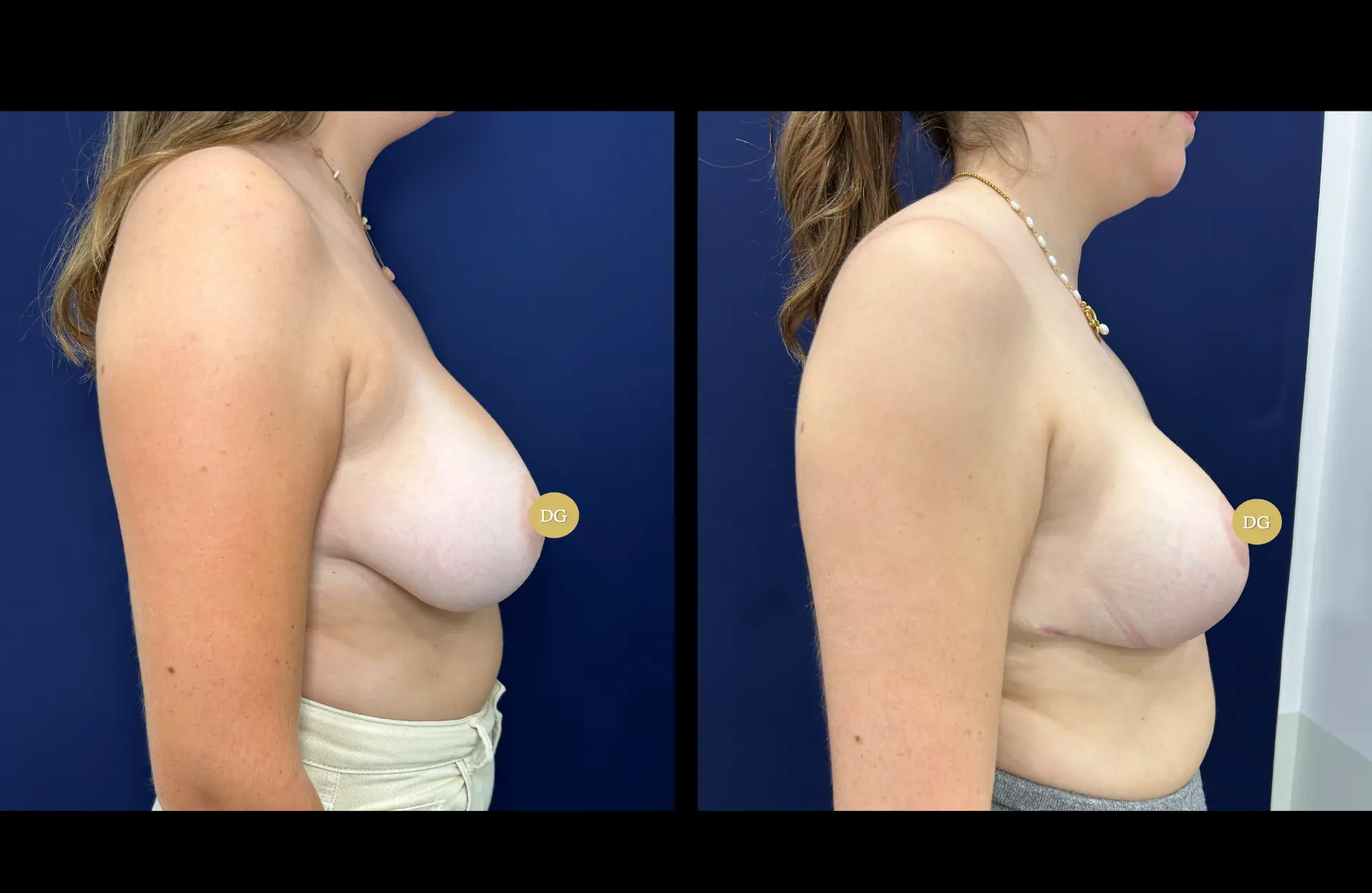 Caso 3 — Mamoplastia de redução — Antes e depois — vista de perfil