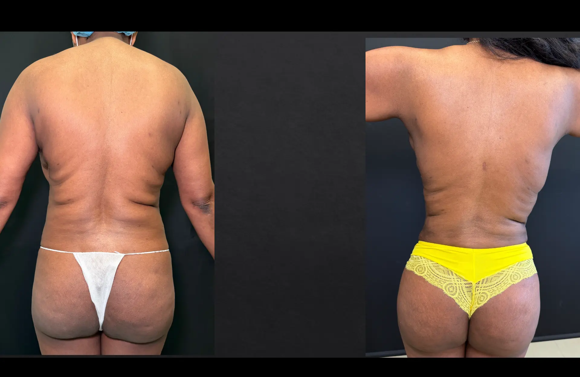Caso 3 — Cirurgia combinada — Antes e depois — vista posterior