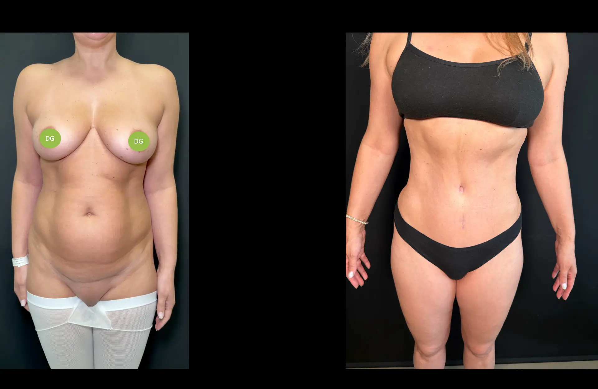 Caso 2 — Lipoabdominoplastia — Antes e depois — vista frontal