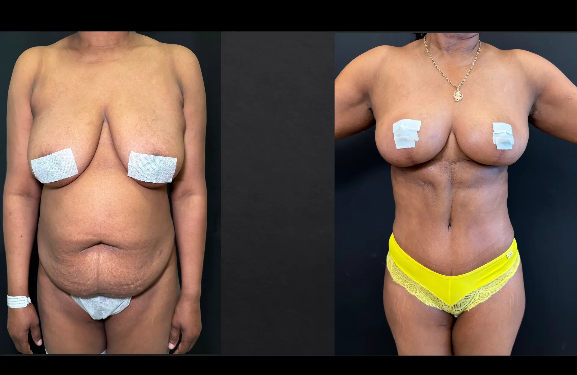 Caso 3 — Cirurgia combinada — Antes e depois — vista frontal (pós-operatório recente)