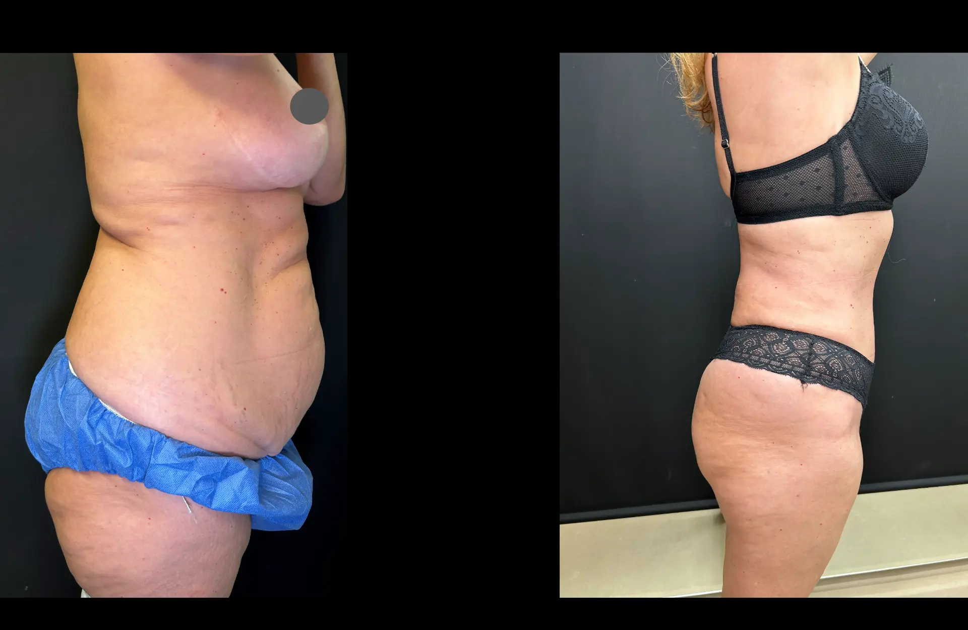 Caso 4 — Lipoabdominoplastia — Antes e depois — vista de perfil