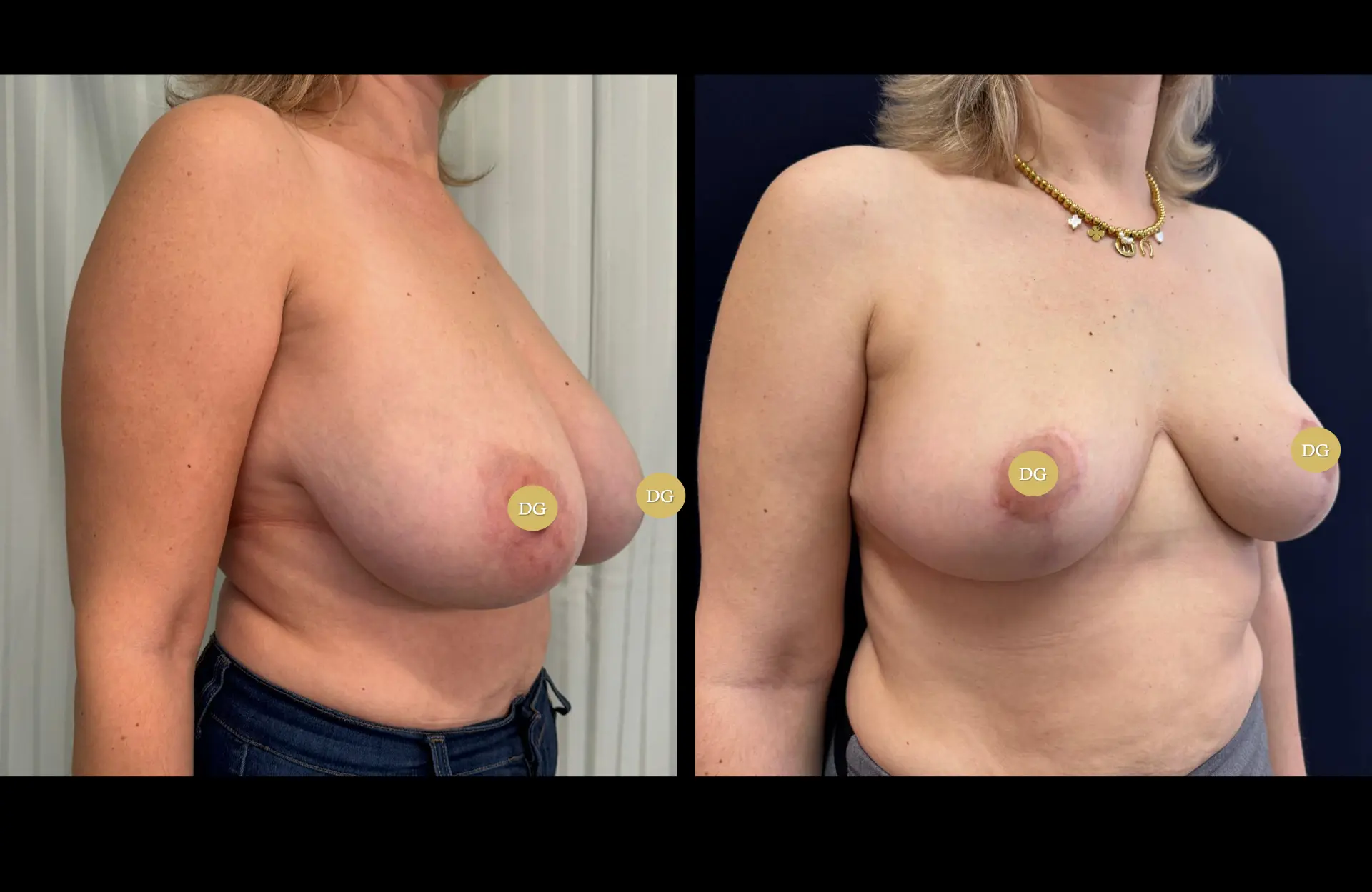 Caso 1 — Mamoplastia de redução — Antes e depois — vista oblíqua