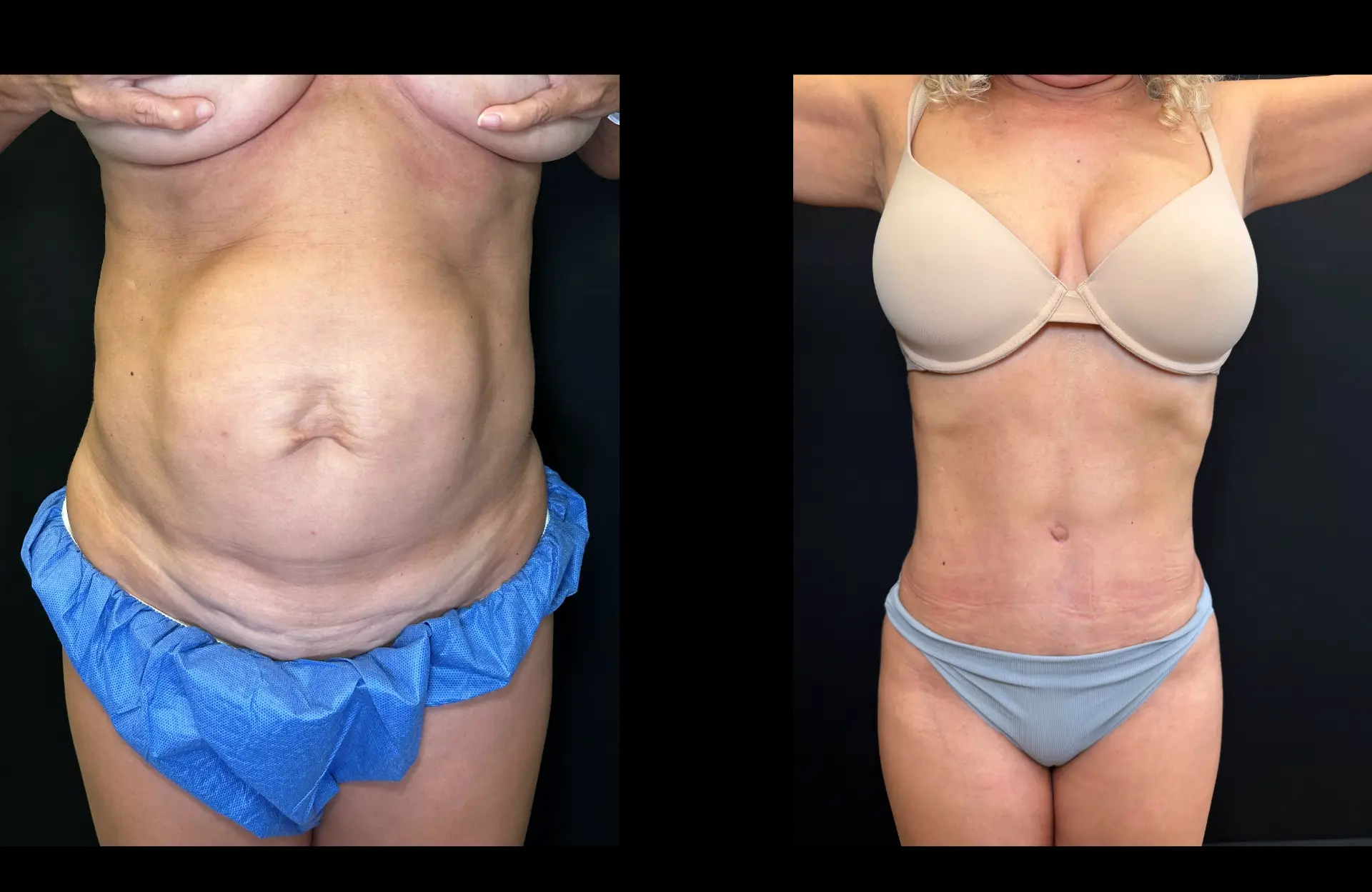 Caso 5 — Lipoabdominoplastia — Antes e depois — vista frontal