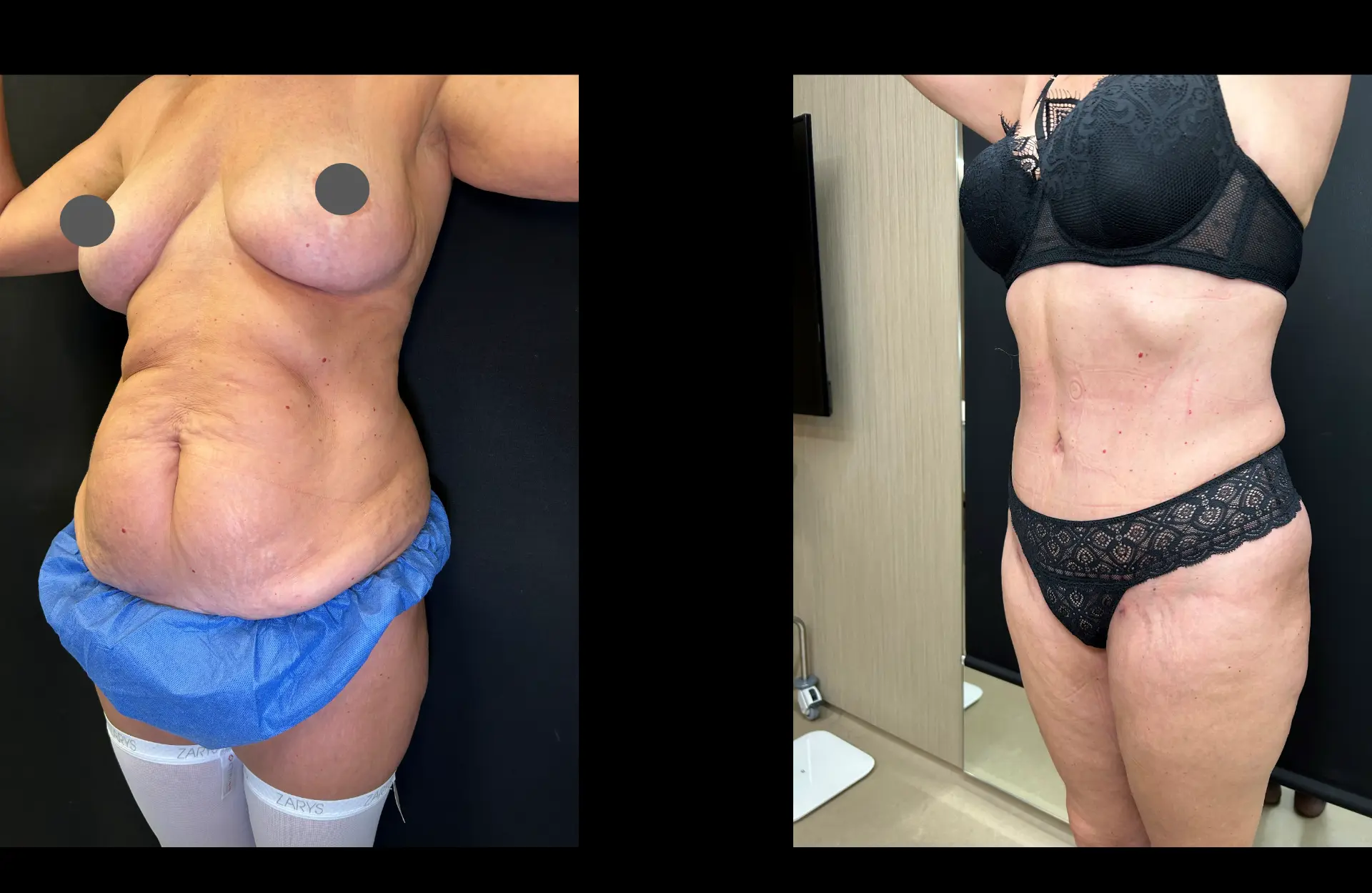 Caso 4 — Lipoabdominoplastia — Antes e depois — vista oblíqua