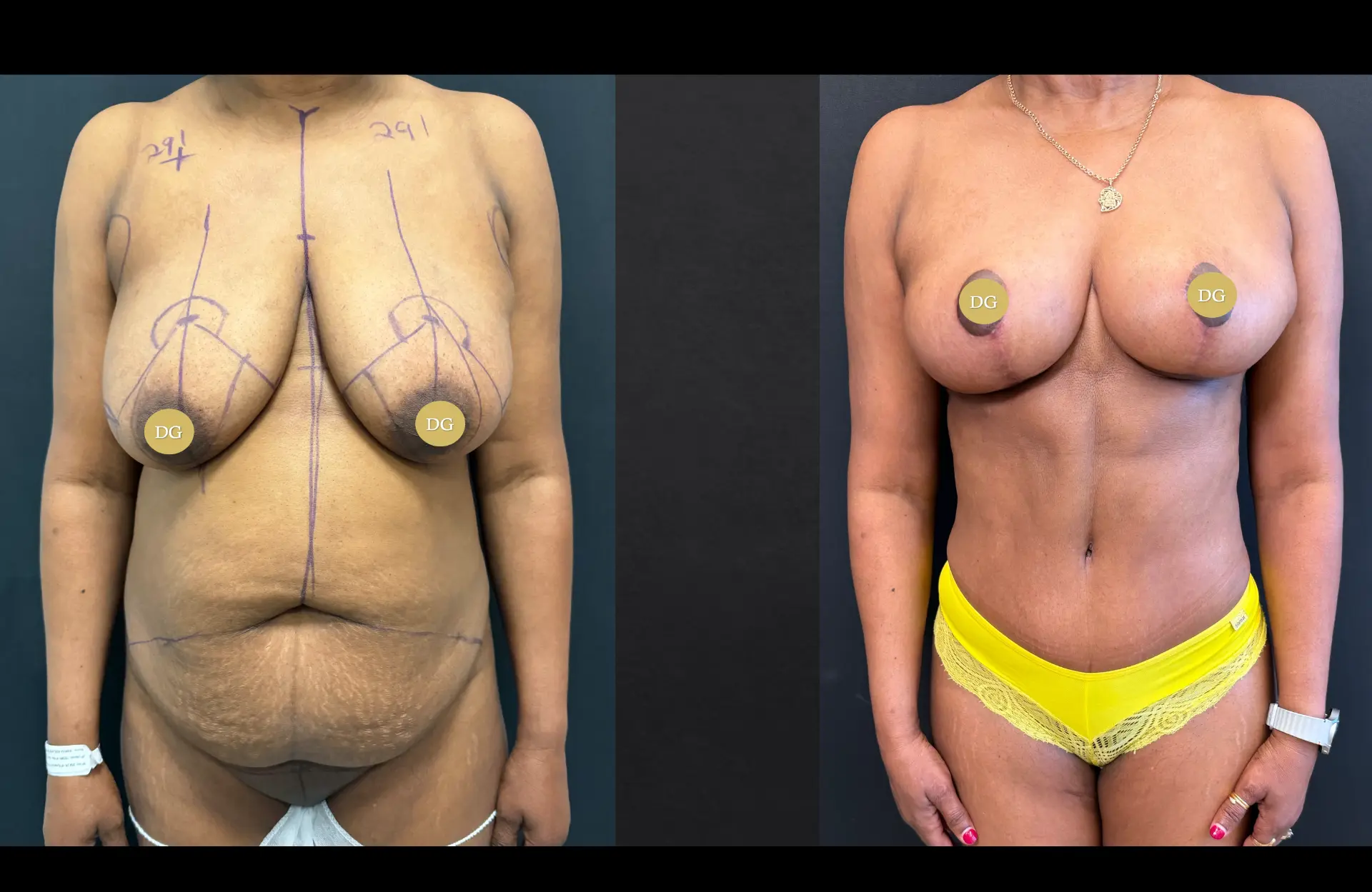 Caso 3 — Cirurgia combinada — Antes e depois — vista frontal