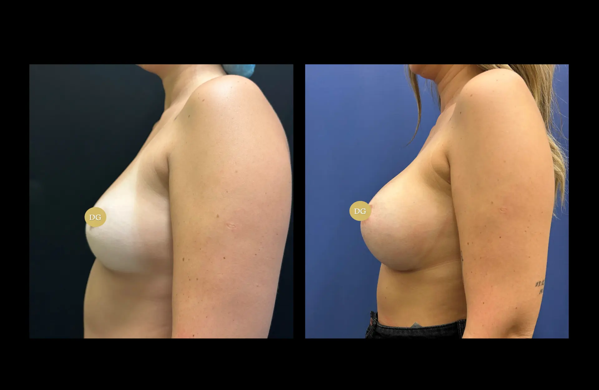 Caso 2 — Mamoplastia de aumento — Antes e depois — vista de perfil
