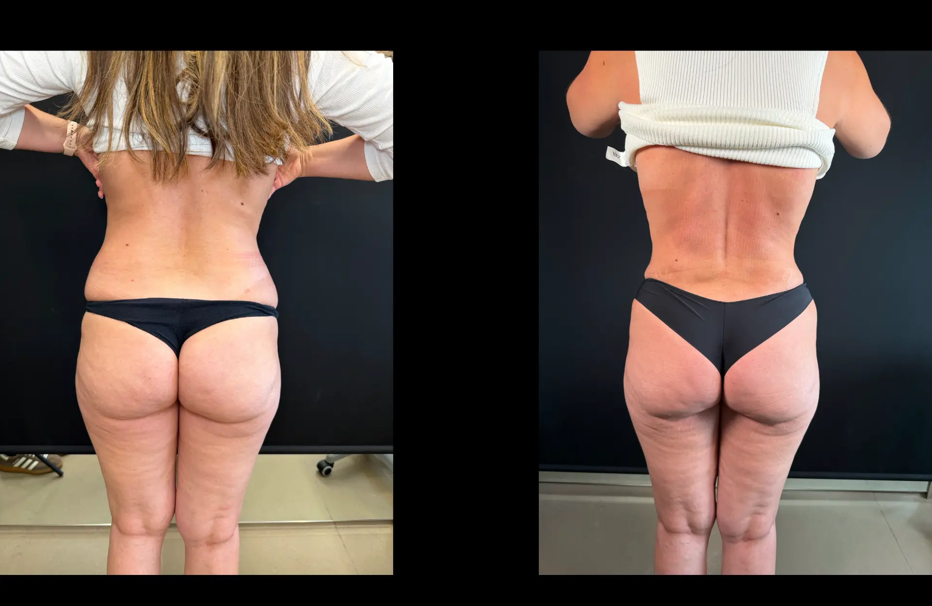 Caso 1 — Lipoabdominoplastia — Antes e depois — vista posterior