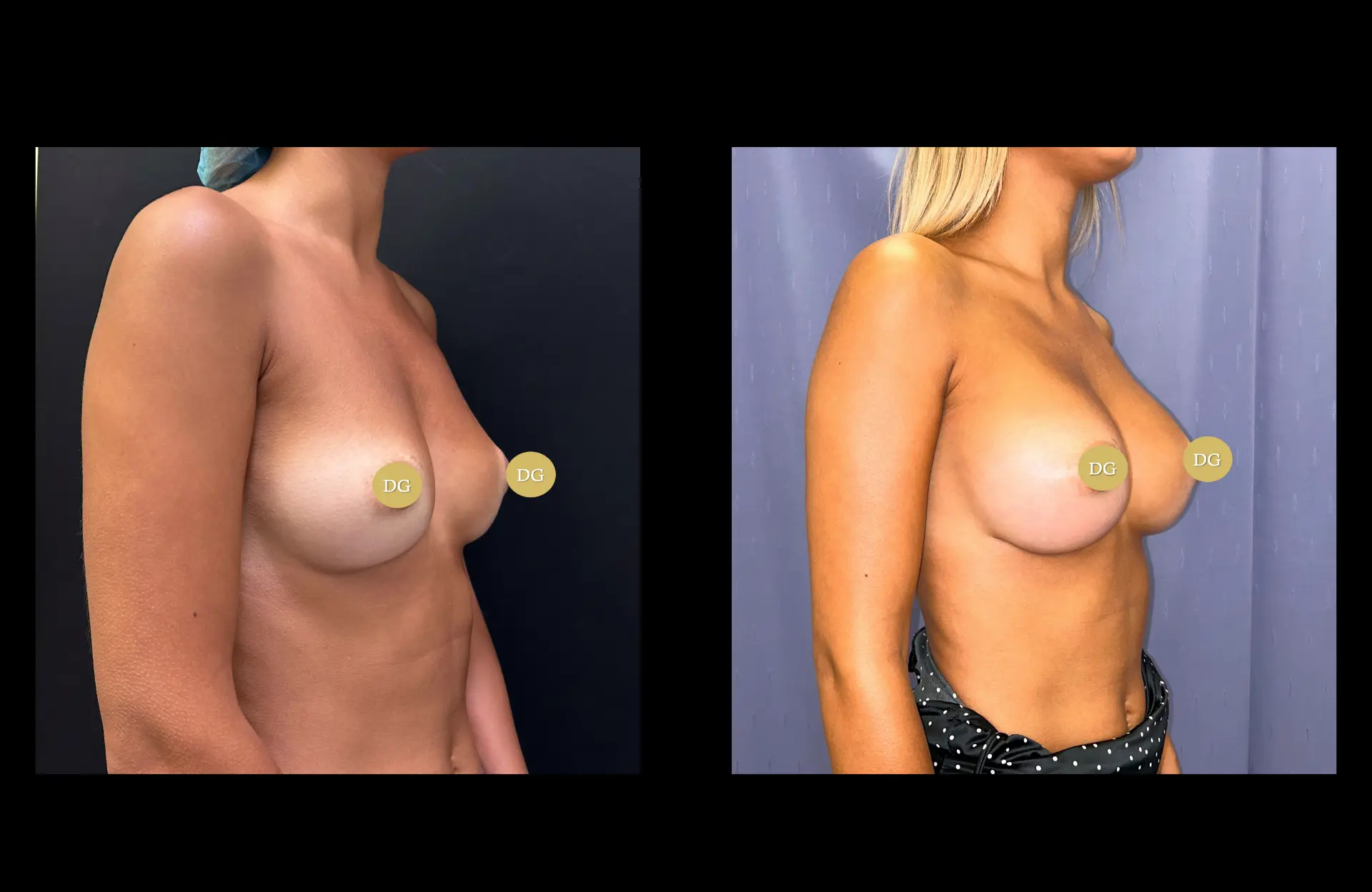 Caso 1 — Mamoplastia de aumento — Antes e depois — vista oblíqua