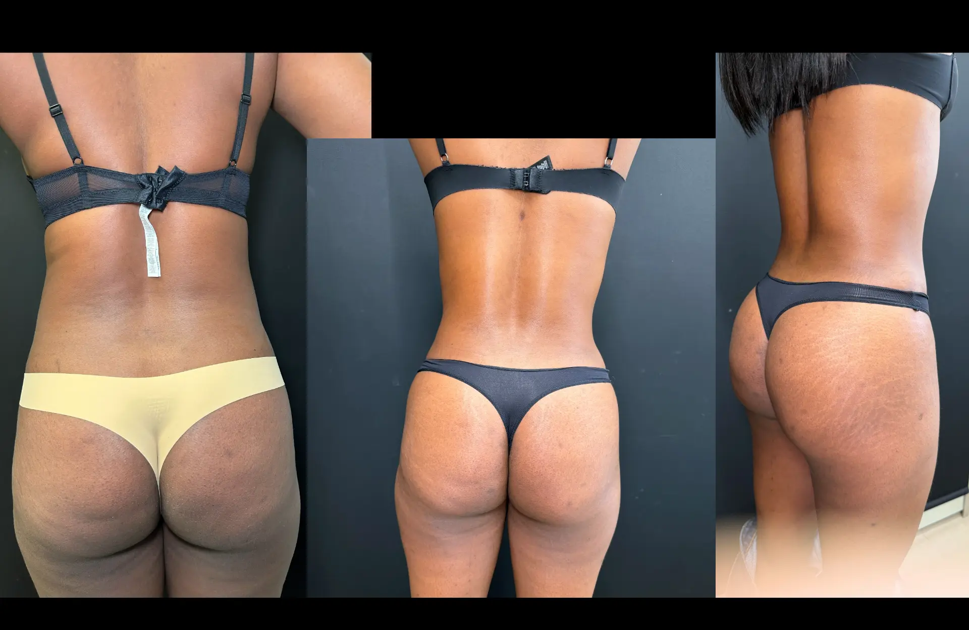 Caso 3 — Lipoabdominoplastia — Antes e depois — vista posterior